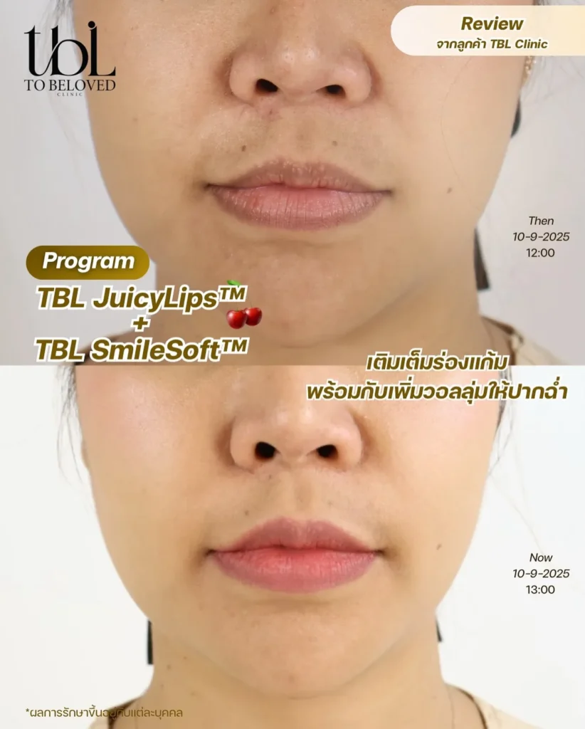ฟิลเลอร์