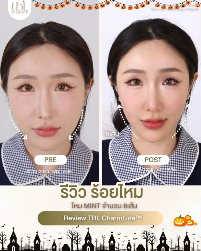 ร้อยไหม